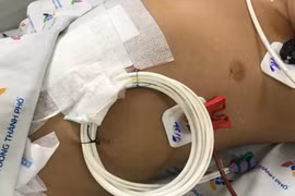 Bé trai 2 tuổi bỏng cổ họng do ống nhầm chai axit