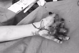 Bị đứt 3 ngón tay vì nghịch pin tích điện