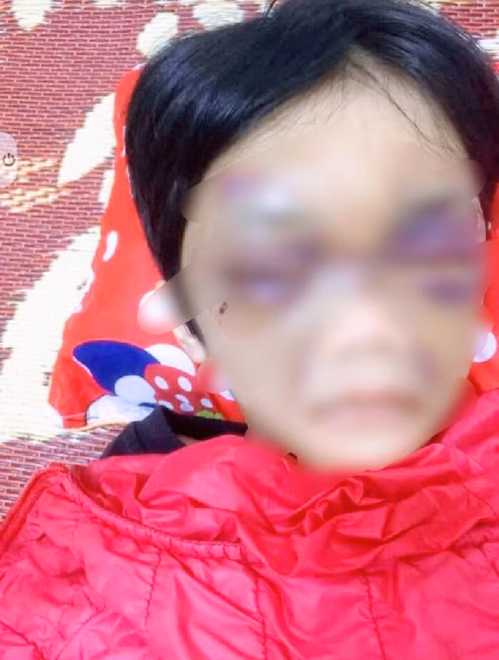 Cháu C. bị chính mẹ đẻ của mình là Vũ Thị Thủy bạo hành. Ảnh: baogiaothong.vn