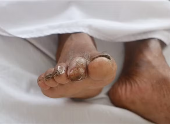 Một bệnh nhân bị vi khuẩn 
