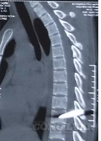 Ảnh kết quả chụp CTScan. Ảnh tư liệu