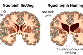 Lần đầu tiên điều trị thành công bệnh di truyền múa giật Huntington