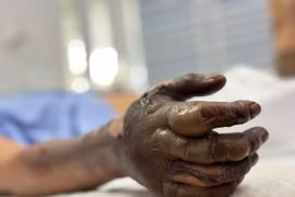 Bị giật điện, nam bệnh nhân giữ lại được bàn tay nhờ cứu chữa kịp thời