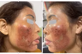 Hàng loạt trường hợp cầu cứu vì peel da không đúng cách