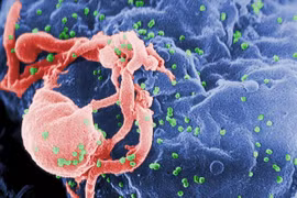 Hơn 4 triệu người có thể tử vong vì AIDS vào năm 2029 vì thiếu nguồn tài trợ