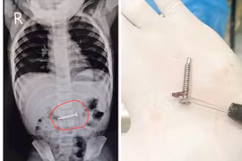 Phú Thọ: Bé gái 19 tháng tuổi thoát nạn sau khi nuốt phải đinh vít dài 2cm