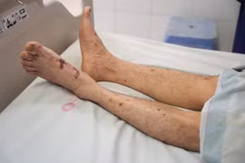 Chế biến thịt lợn sống, người đàn ông 61 tuổi nhiễm liên cầu lợn suýt tử vong