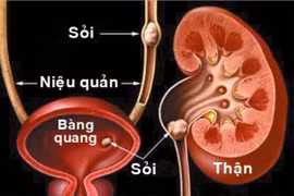 Chuyên gia bật mí: Phòng ngừa và điều trị kịp thời về sỏi tiết niệu