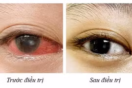Cô gái 20 tuổi bị loét giác mạc vì lạm dụng kính áp tròng thay kính thường