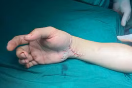 Nối thành công bàn tay bị chém đứt lìa cho nam Tiktoker ở Thái Nguyên
