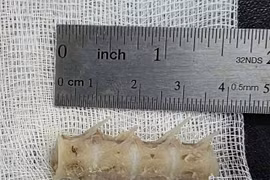 Xương cá dài 4cm găm chặt cổ họng cụ ông 99 tuổi
