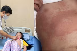 Phú Thọ: Nhiều trẻ nhập viện vì ban nhiễm khuẩn