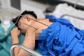 Cứu sống nam thanh niên 17 tuổi bị đinh ba đâm xuyên tim