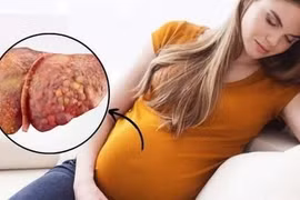 Thoát "cửa tử" sau khi được thay gần như toàn bộ máu: Sản phụ nguy kịch vì gan nhiễm mỡ cấp thai kỳ