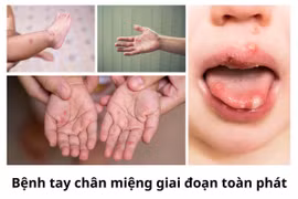 Bệnh tay chân miệng leo thang, Bộ Y tế yêu cầu khẩn, ngăn chặn dịch lây lan trên diện rộng
