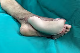 Giữ lại bàn chân đang thối rữa cho bệnh nhân đái tháo đường