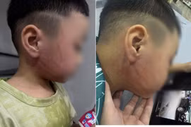 Xác minh vụ bé 4 tuổi nghi bị cô giáo đánh bầm tím mặt