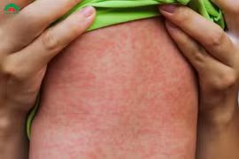 Sởi vào chu kỳ bùng phát 5 năm 1 lần: Cảnh báo nhiều trẻ biến chứng nặng