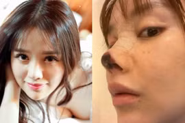 Những 'bi kịch' phẫu thuật thẩm mỹ của sao Hoa ngữ