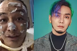 Nam rapper Từ Chân Chân bị bỏng nặng, mặt biến dạng
