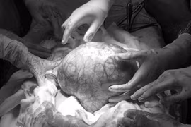 Người đàn ông dính u 3,5 kg sau khi uống thực phẩm chức năng chợ trời