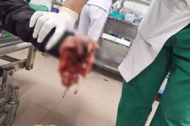 Hai anh em bị dập nát bàn tay vì nghịch pháo