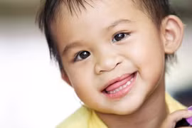 Tổ chức Operation Smile sẽ tiếp tục triển khai phẫu thuật dị tật hở hàm ếch tại Việt Nam