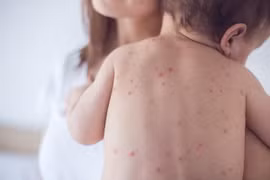Hà Nội: Hơn 1.000 ca mắc sởi và đang có chiều hướng gia tăng