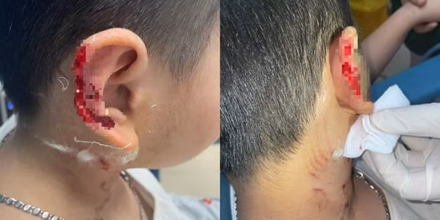 bi cho la phu quoc vo can tai be trai thuong tich bien dang hinh 1