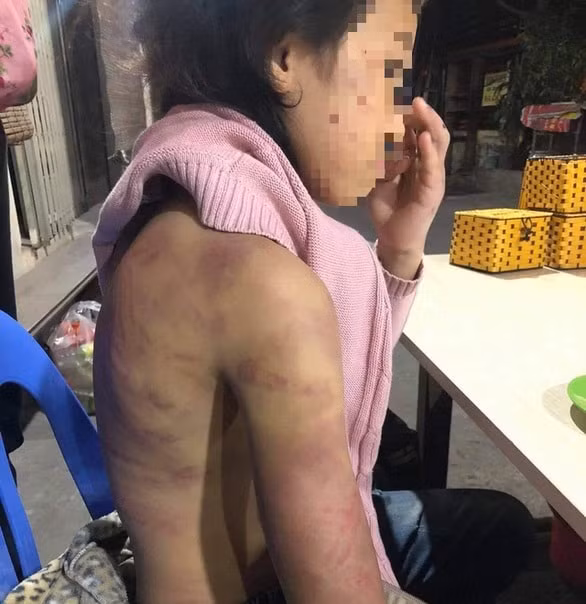 Cháu B. bị bạo hành, xâm hại suốt một thời gian dài.