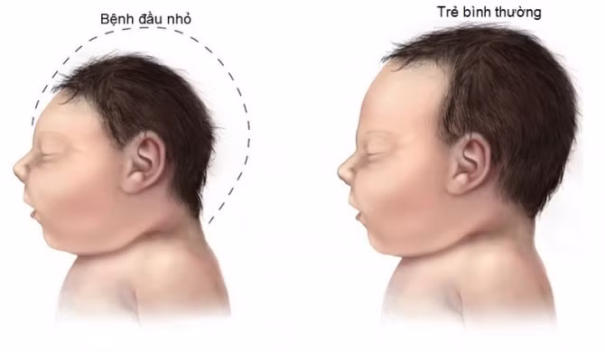Chuyên gia nói gì về bệnh nhân mới mắc Zika tại Đà Nẵng?