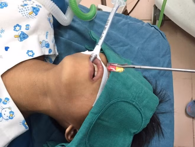 Hình ảnh viên thuốc còn cả vỏ được bác sĩ gắp ra từ thực quản bệnh nhi 10 tuổi. Ảnh: thanhnien.vn