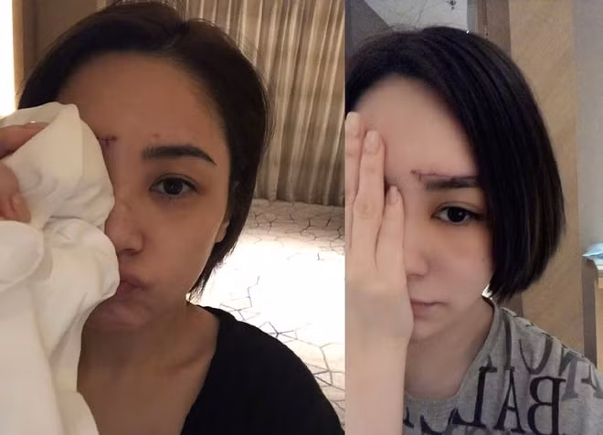 Vết thương dài trên mặt Chung Hân Đồng.