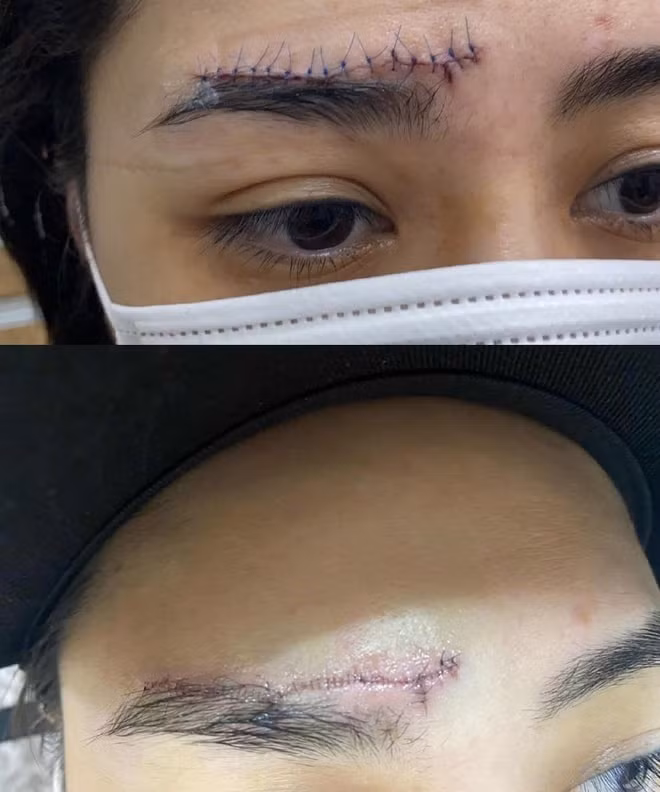 Vết sẹo ảnh hưởng tới nhan sắc của nữ diễn viên. Cô cho biết tình trạng phục hồi chấn thương đang diễn biến tốt.
