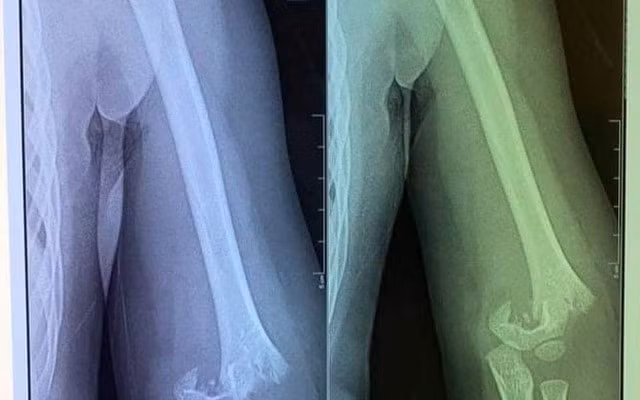 Hình ảnh chụp phim của cháu bé bị gãy tay tại trường. Ảnh: TL.