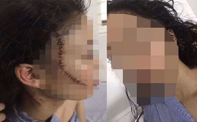 Cô gái bị bạn rạch nhiều nhát lên mặt, cổ và tay. Ảnh: CACC