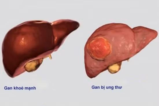 Sự sạm đen của da mặt cho thấy có thể có dấu hiệu của ung thư gan