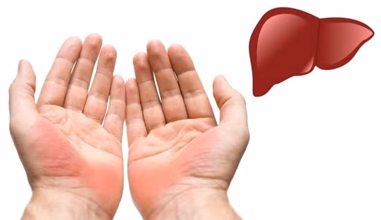 Một trong những dấu hiệu đầu tiên về ung thư gan đó là trên lòng bàn tay xuất hiện màu đỏ ửng hoặc thậm chí nổi ban đỏ