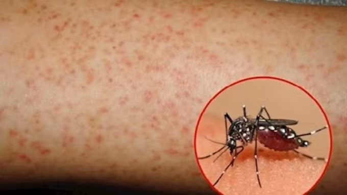 Sốt xuất huyết chỉ lây qua muỗi Aedes (muỗi vằn) đốt hút máu người mắc bệnh hoặc người nhiễm vi rút Dengue không triệu chứng, sau đó lại đốt người khỏe mạnh thì sẽ truyền virus cho người lành qua vết đốt. Do đó, sốt xuất huyết có thể lây lan sang người khác qua muỗi đốt và phát triển thành dịch. Ảnh TL.