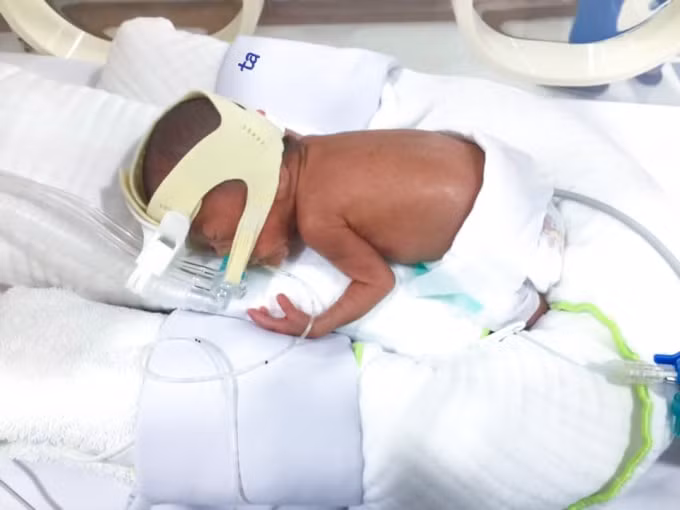Bé gái con chị N.T.D chào đời tại khoa Sản, BVĐK Tâm Anh, Hà Nội lúc 24 tuần 5 ngày, cân nặng chỉ 550 gram.