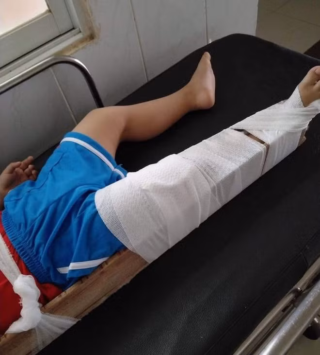 Hình ảnh bé P. bị gãy chân phải. Ảnh: zingnews.vn
