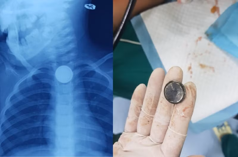 Các bác sĩ lấy dị vật là viên pin cúc áo ra khỏi thực quản bệnh nhi. Ảnh: doisongvietnam.vn
