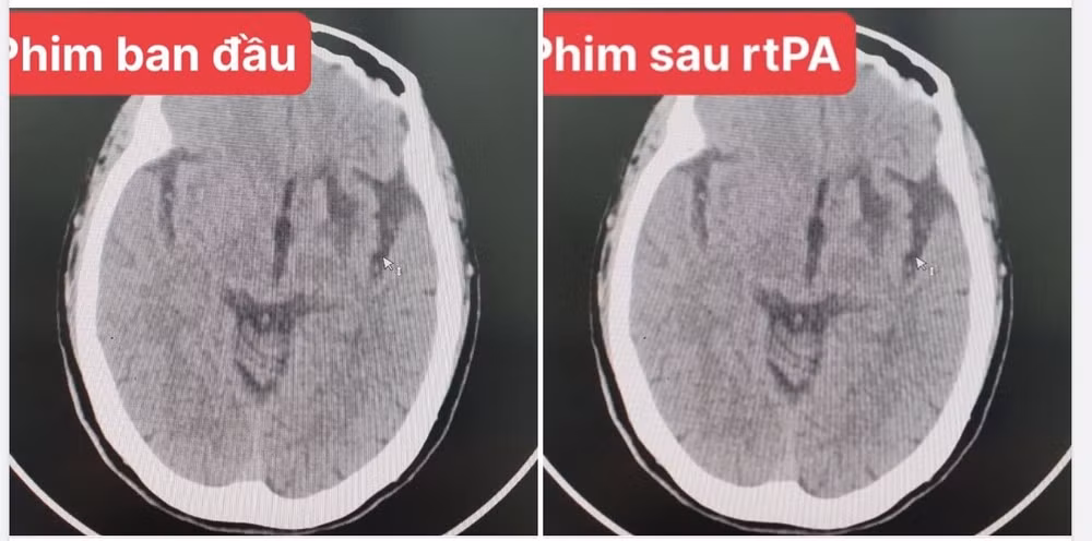 benh nhan bi nhoi mau nao lan dau duoc cuu bang cach rat dac biet hinh 1