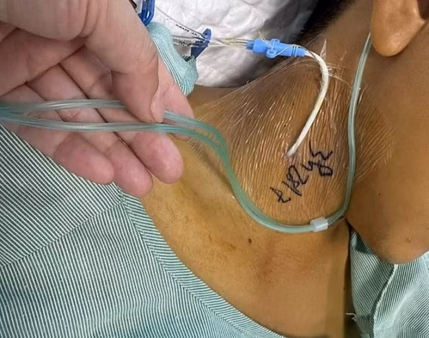 4 nguoi bi ngo doc tan mau sau khi an xoi mau tu cay co hinh 2