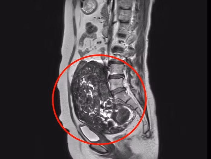 Khối nhân xơ tử cung trong ổ bụng bệnh nhân được phát hiện bởi máy MRI 3.0 Tesla tích hợp trí tuệ nhân tạo (AI)_Góc nhìn từ ngang
