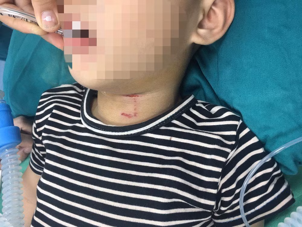 Hình ảnh cháu bé D.V.B. bị chó tấn công làm rách vùng cổ và thủng khí quản. Ảnh: tienphong.vn
