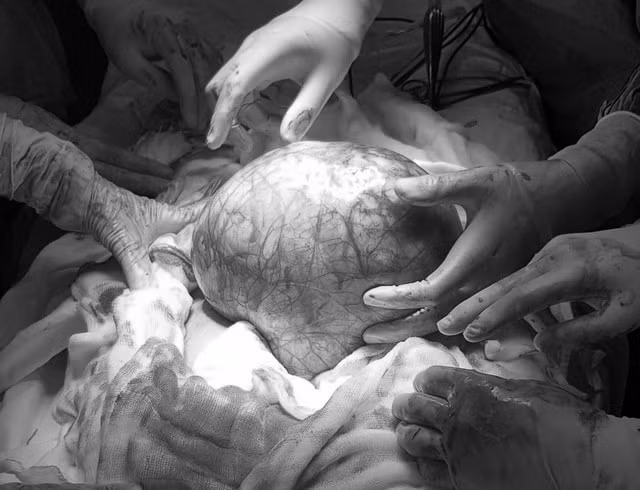 Khối u sau khi được bóc tách có cân nặng lên tới 3,5kg tương đương với trọng lượng một em bé trong bụng mẹ. Ảnh: dantri.com.vn