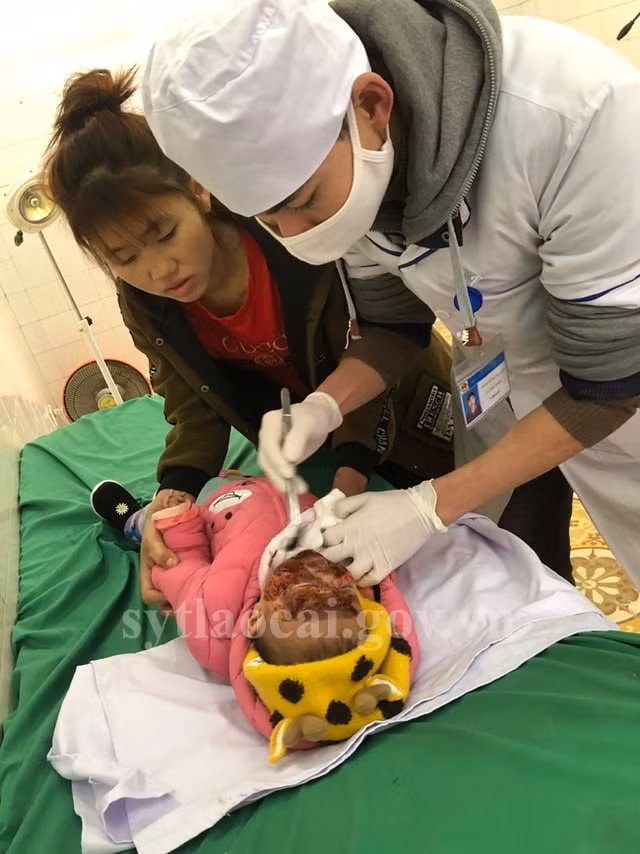 Bé M.B.T. được chăm sóc vết thương. Ảnh: Sở y tế Lào Cai