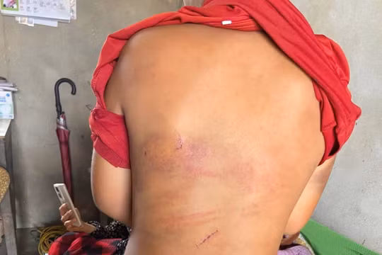 Công an vào cuộc xác minh vụ cháu bé 10 tuổi nghi bị bạo hành