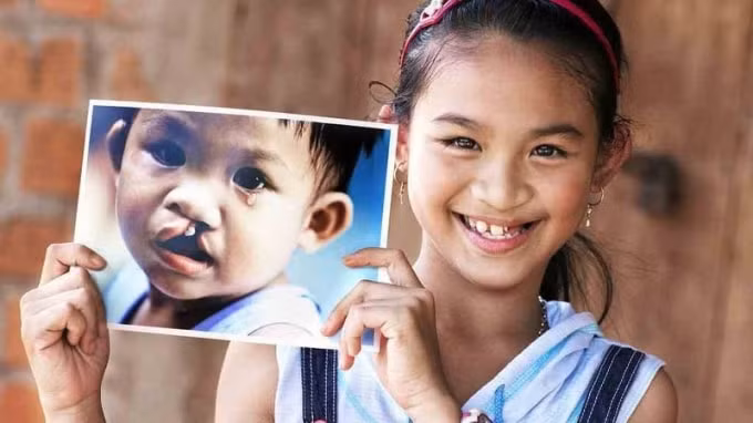 Một bệnh nhi đã được phẫu thuật miễn phí bởi Operation Smile. Ảnh: Operation Smile